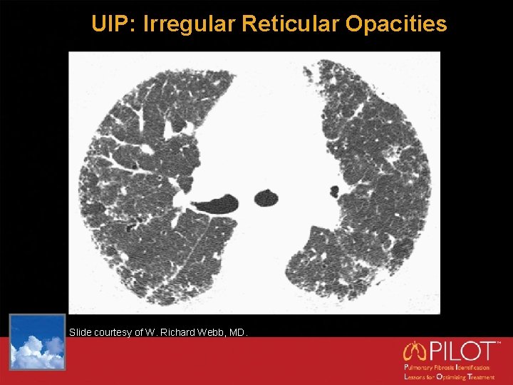 UIP: Irregular Reticular Opacities Slide courtesy of W. Richard Webb, MD. 
