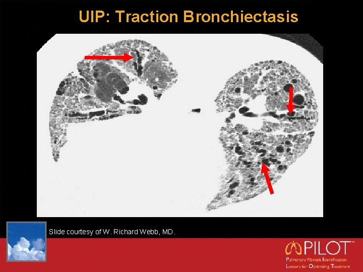 UIP: Traction Bronchiectasis Slide courtesy of W. Richard Webb, MD. 