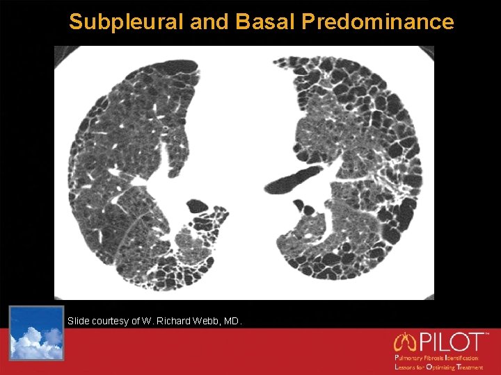 Subpleural and Basal Predominance Slide courtesy of W. Richard Webb, MD. 