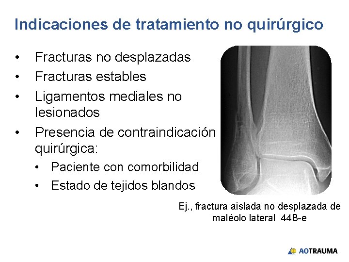 Indicaciones de tratamiento no quirúrgico • • Fracturas no desplazadas Fracturas estables Ligamentos mediales