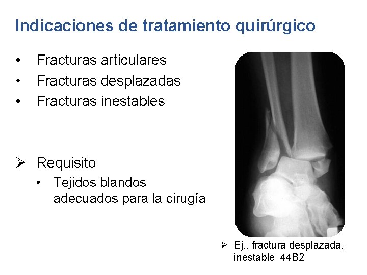 Indicaciones de tratamiento quirúrgico • • • Fracturas articulares Fracturas desplazadas Fracturas inestables Ø