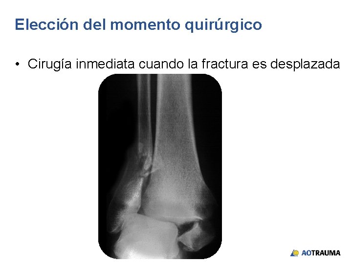 Elección del momento quirúrgico • Cirugía inmediata cuando la fractura es desplazada 