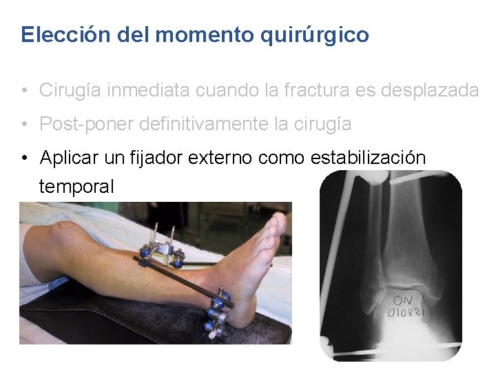 Elección del momento quirúrgico • Cirugía inmediata cuando la fractura es desplazada • Post-poner