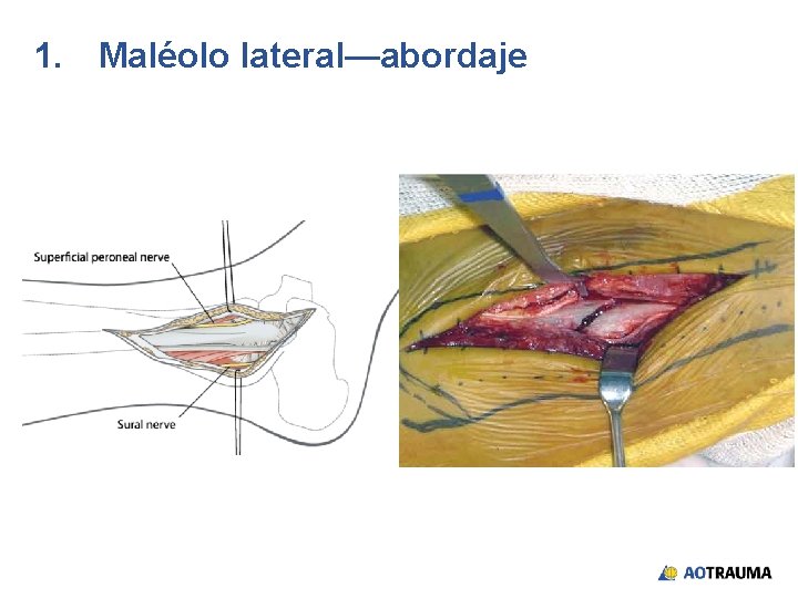 1. Maléolo lateral—abordaje 