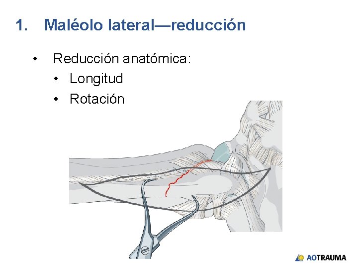 1. Maléolo lateral—reducción • Reducción anatómica: • Longitud • Rotación 