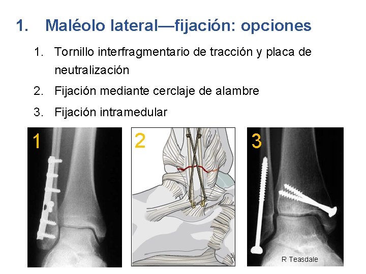 1. Maléolo lateral—fijación: opciones 1. Tornillo interfragmentario de tracción y placa de neutralización 2.