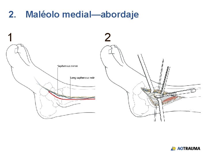 2. Maléolo medial—abordaje 1 2 