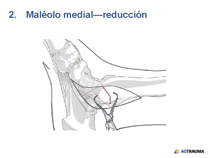2. Maléolo medial—reducción 