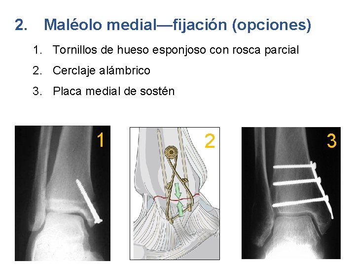 2. Maléolo medial—fijación (opciones) 1. Tornillos de hueso esponjoso con rosca parcial 2. Cerclaje