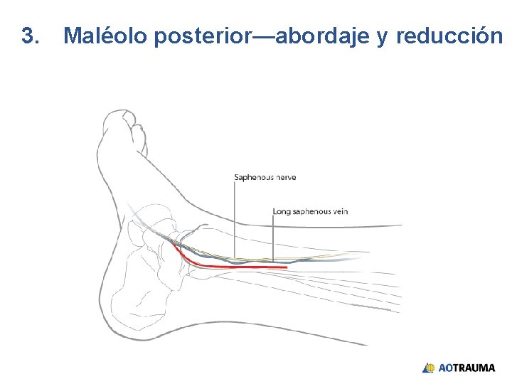 3. Maléolo posterior—abordaje y reducción 