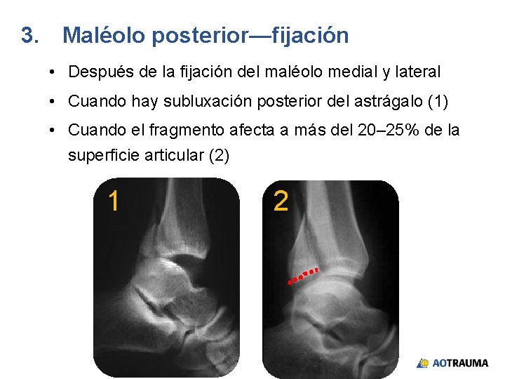 3. Maléolo posterior—fijación • Después de la fijación del maléolo medial y lateral •