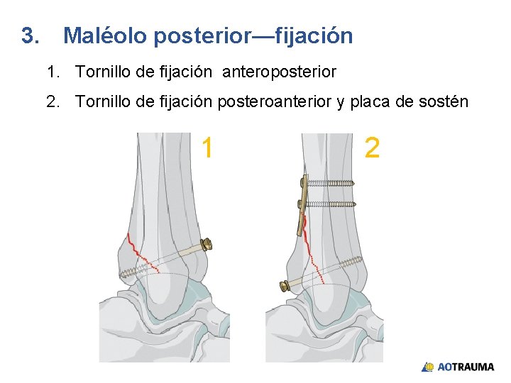 3. Maléolo posterior—fijación 1. Tornillo de fijación anteroposterior 2. Tornillo de fijación posteroanterior y