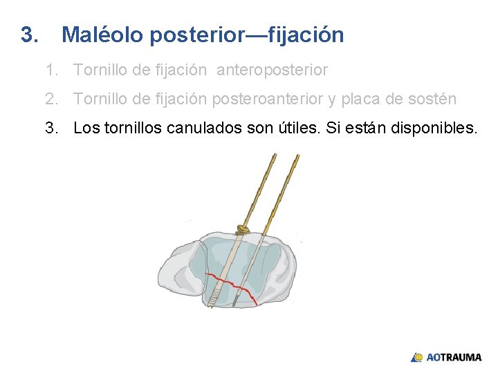 3. Maléolo posterior—fijación 1. Tornillo de fijación anteroposterior 2. Tornillo de fijación posteroanterior y