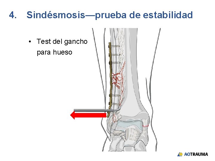 4. Sindésmosis—prueba de estabilidad • Test del gancho para hueso 