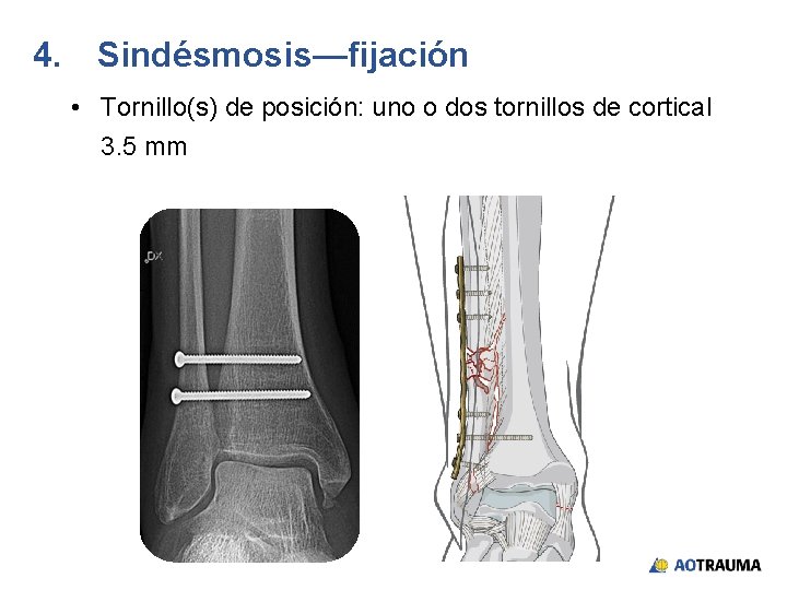 4. Sindésmosis—fijación • Tornillo(s) de posición: uno o dos tornillos de cortical 3. 5