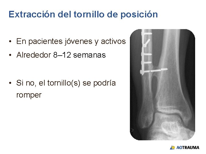 Extracción del tornillo de posición • En pacientes jóvenes y activos • Alrededor 8–