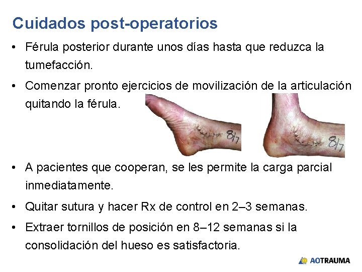 Cuidados post-operatorios • Férula posterior durante unos días hasta que reduzca la tumefacción. •