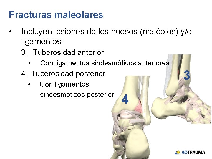 Fracturas maleolares • Incluyen lesiones de los huesos (maléolos) y/o ligamentos: 3. Tuberosidad anterior