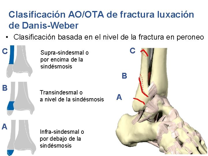 Clasificación AO/OTA de fractura luxación de Danis-Weber • Clasificación basada en el nivel de