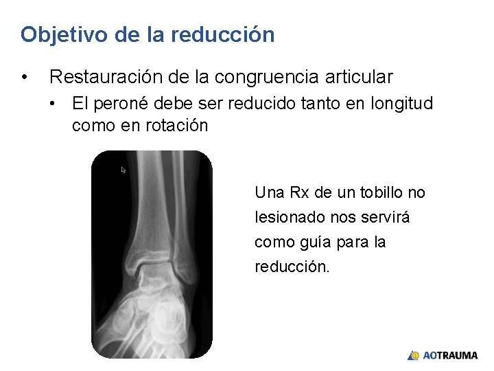 Objetivo de la reducción • Restauración de la congruencia articular • El peroné debe