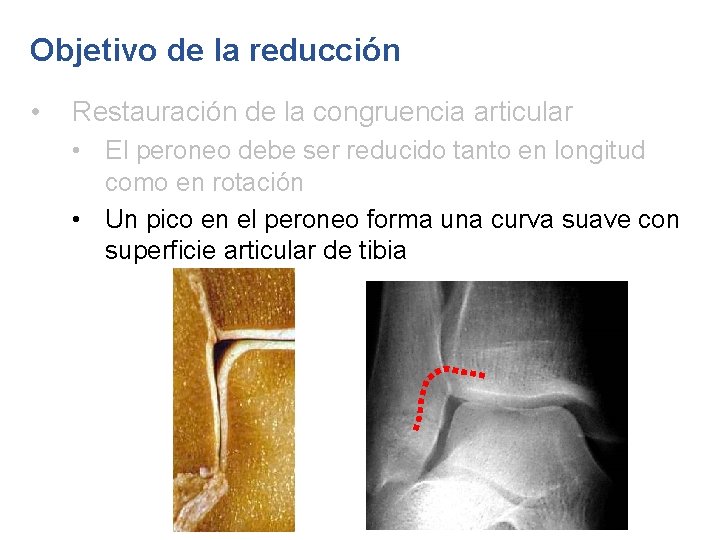 Objetivo de la reducción • Restauración de la congruencia articular • El peroneo debe