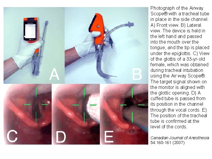 Photograph of the Airway Scope® with a tracheal tube in place in the side