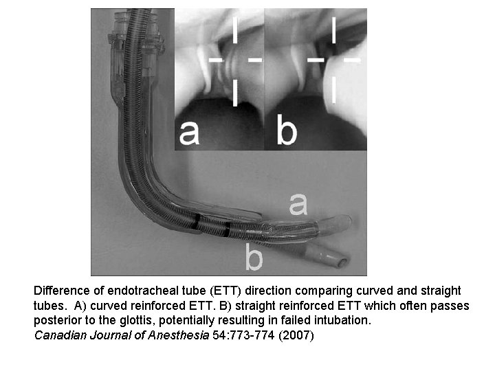 Difference of endotracheal tube (ETT) direction comparing curved and straight tubes. A) curved reinforced