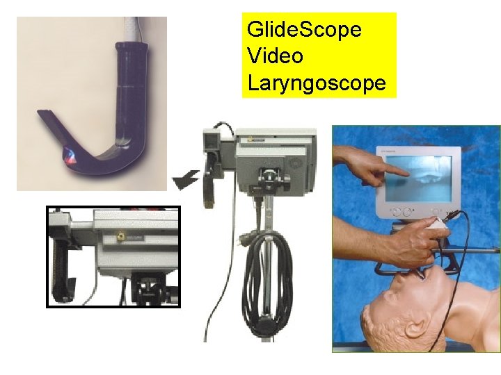 Glide. Scope Video Laryngoscope 