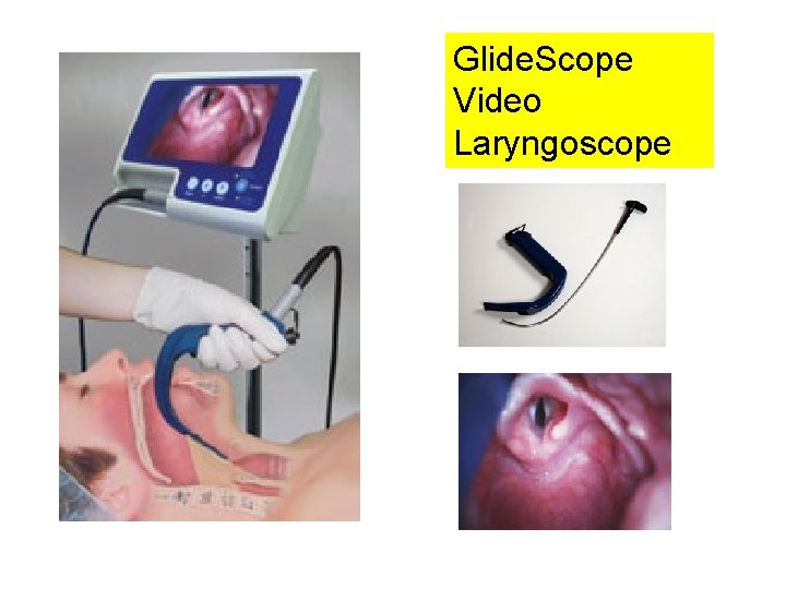 Glide. Scope Video Laryngoscope 