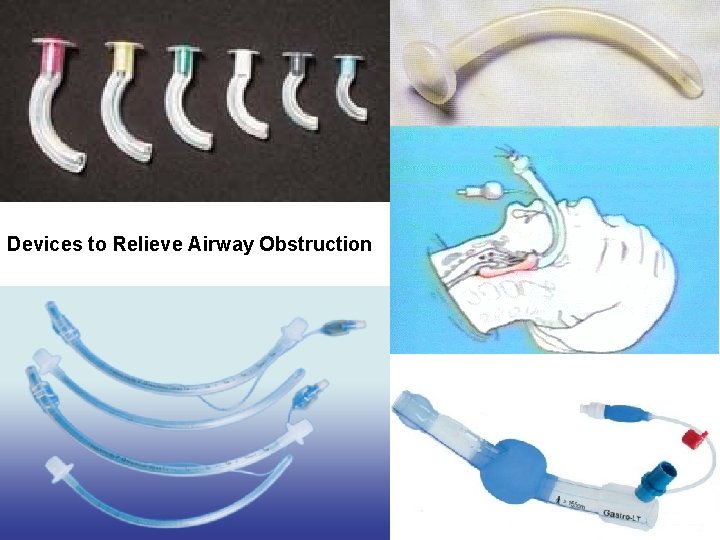 Devices to Relieve Airway Obstruction 