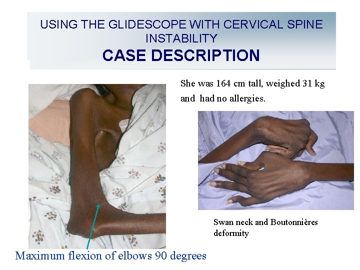 USING THE GLIDESCOPE WITH CERVICAL SPINE INSTABILITY CASE DESCRIPTION She was 164 cm tall,