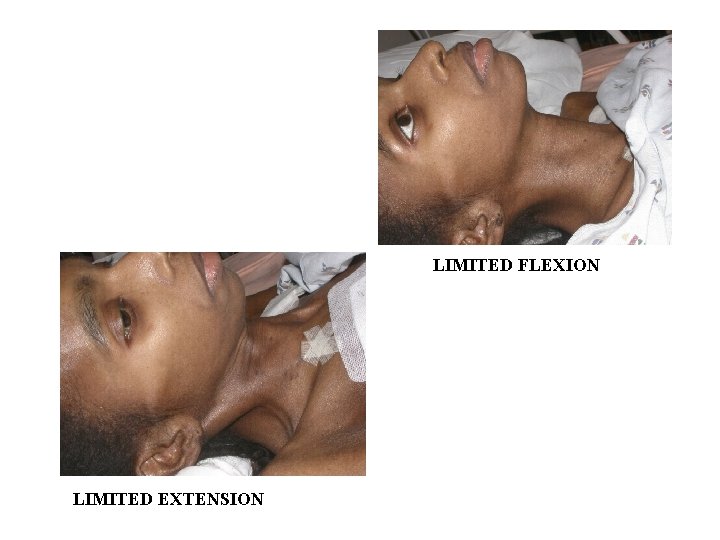 LIMITED FLEXION LIMITED EXTENSION 