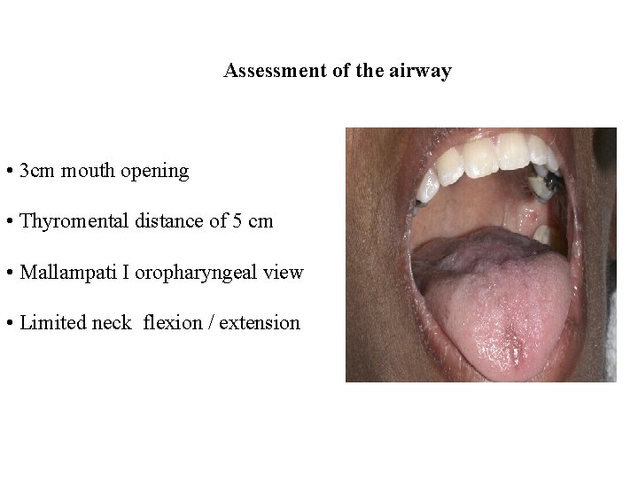 Assessment of the airway • 3 cm mouth opening • Thyromental distance of 5