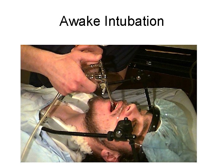 Awake Intubation 