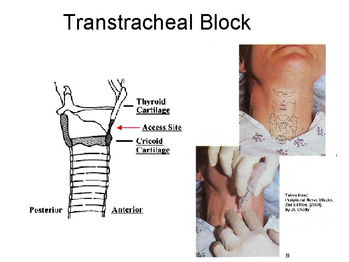 Transtracheal Block 