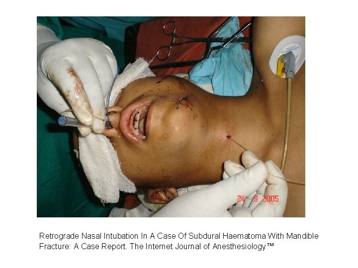 Retrograde Nasal Intubation In A Case Of Subdural Haematoma With Mandible Fracture: A Case