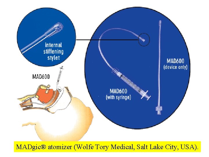 MADgic® atomizer (Wolfe Tory Medical, Salt Lake City, USA). 