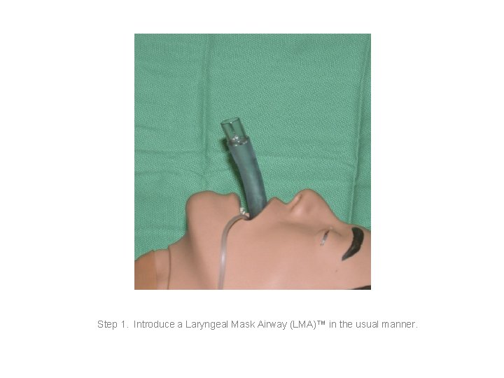 Step 1. Introduce a Laryngeal Mask Airway (LMA)™ in the usual manner. 