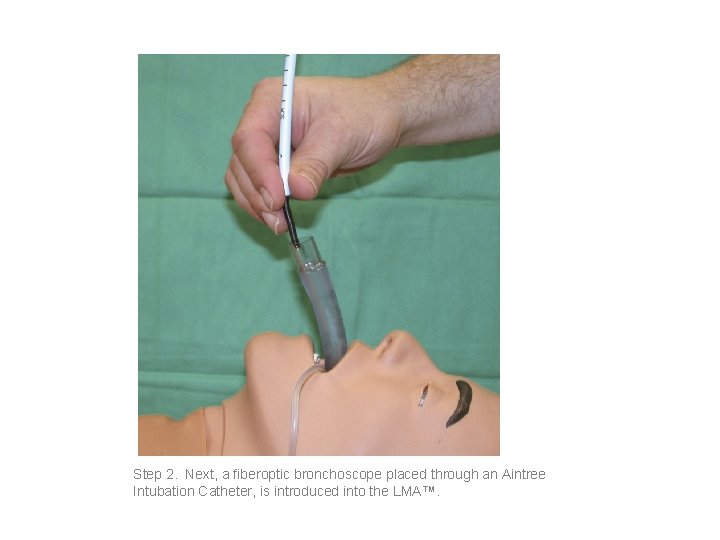 Step 2. Next, a fiberoptic bronchoscope placed through an Aintree Intubation Catheter, is introduced