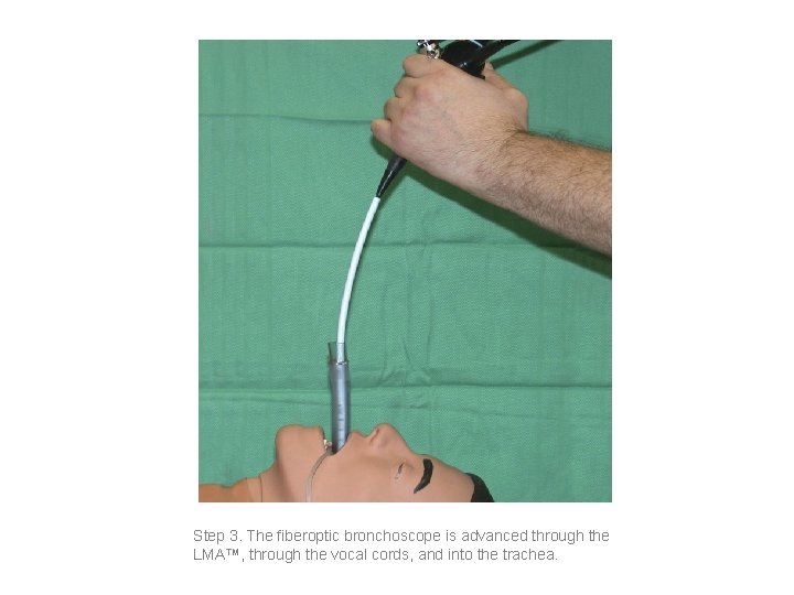 Step 3. The fiberoptic bronchoscope is advanced through the LMA™, through the vocal cords,