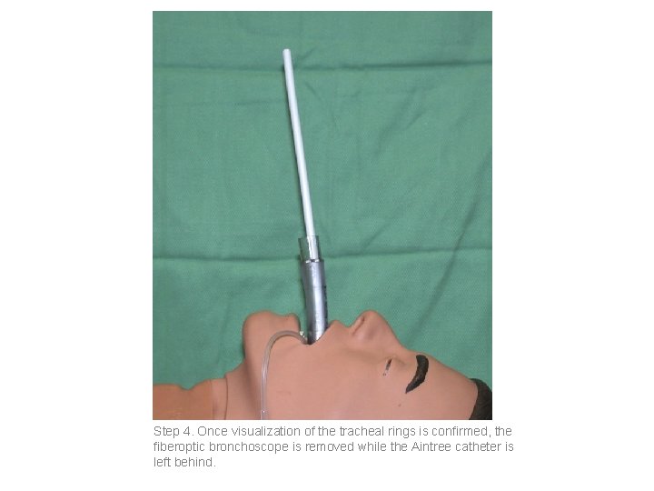 Step 4. Once visualization of the tracheal rings is confirmed, the fiberoptic bronchoscope is