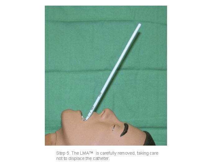 Step 5. The LMA™ is carefully removed, taking care not to displace the catheter.