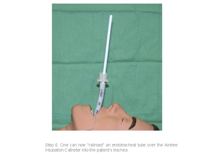 Step 6. One can now “railroad” an endotracheal tube over the Aintree Intubation Catheter