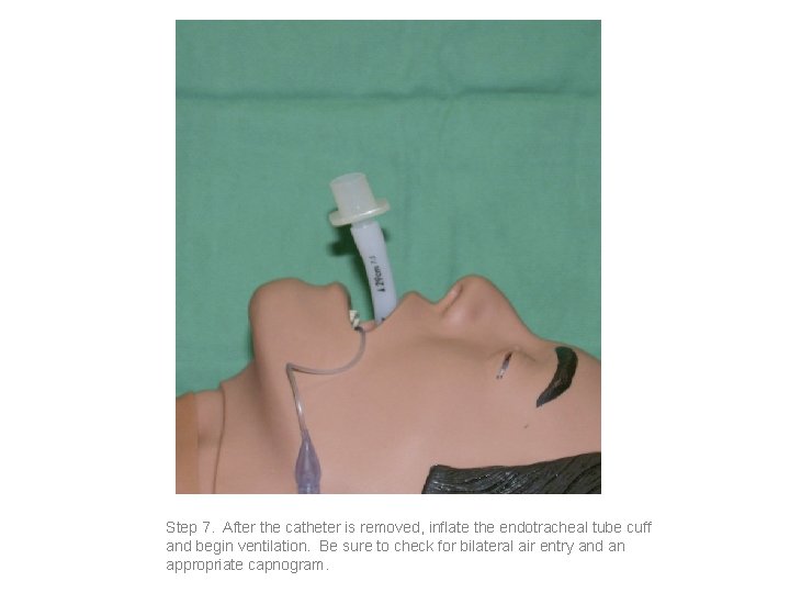 Step 7. After the catheter is removed, inflate the endotracheal tube cuff and begin