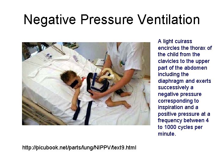 Negative Pressure Ventilation A light cuirass encircles the thorax of the child from the