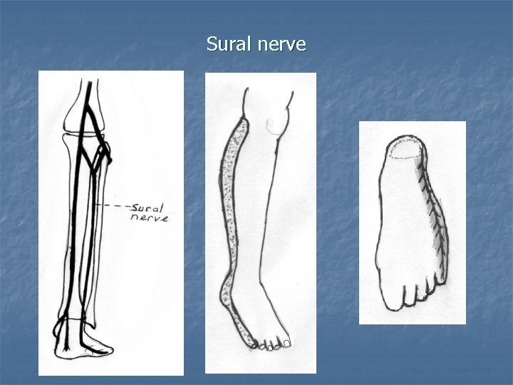 Sural nerve 