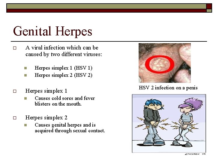 Genital Herpes o A viral infection which can be caused by two different viruses: