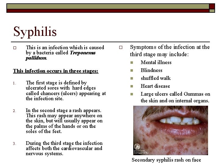 Syphilis o This is an infection which is caused by a bacteria called Treponema