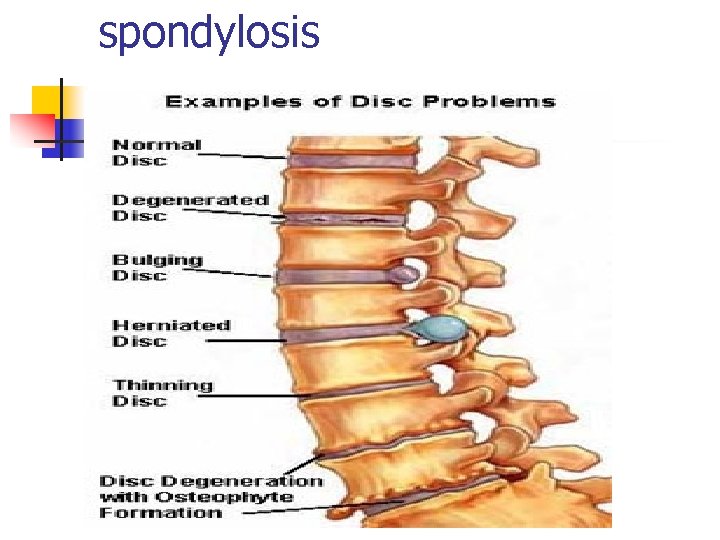 spondylosis 