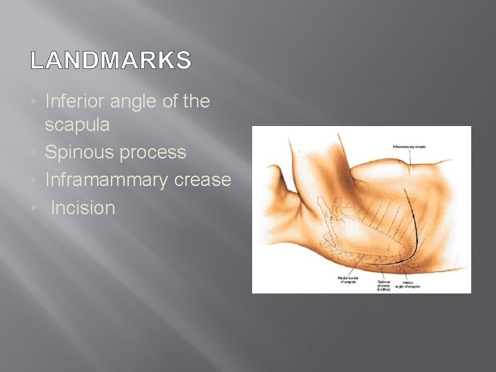  • Inferior angle of the scapula • Spinous process • Inframammary crease •